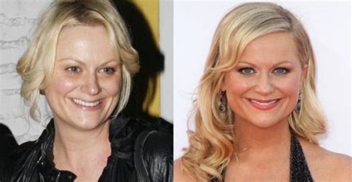 Amy Poehler Plastic Surgery