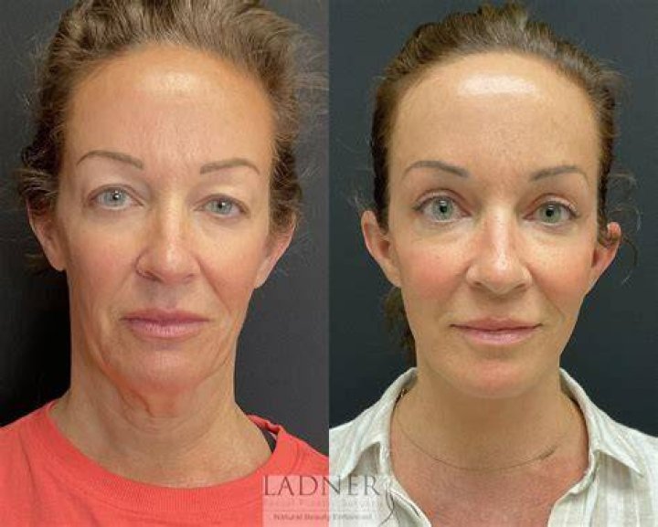 Amy Poehler Underwent Facelift Surgery? Before and After Images