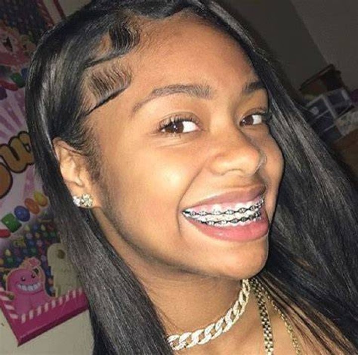 Braces That Look Like Grills: A Unique Fashion Statement