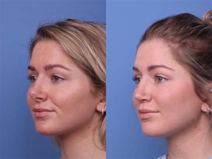 Brooke Shields' Nose Job Before And Its Impact