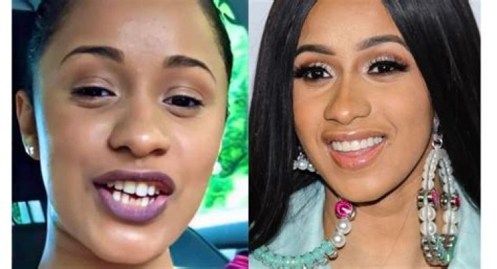 Cardi B Teeth Then And Now