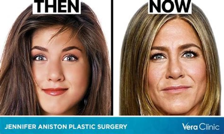 Did Jennifer Aniston Get A Plastic Surgery?