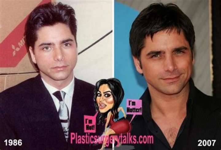 Did John Stamos have Plastic Surgery? |