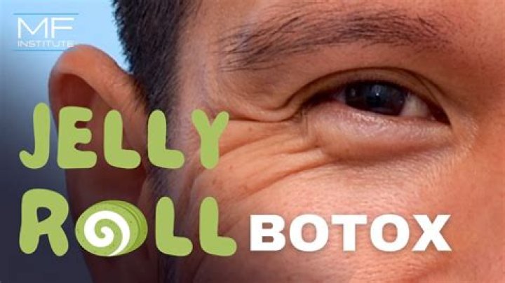 Discover The Latest In Botox Jelly Roll