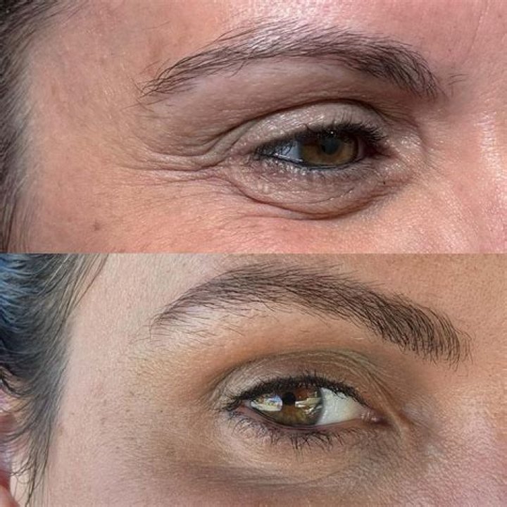 Discover The Secrets Of Botox For Jelly Roll: Unveiling Youthful Eyes