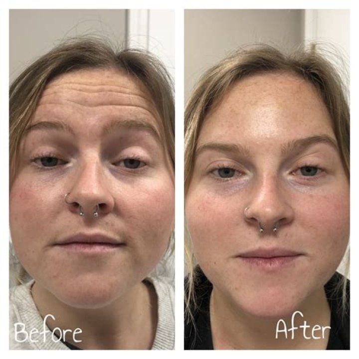 Discover The Secrets Of Jelly Roll Botox: Unlocking A Youthful Glow