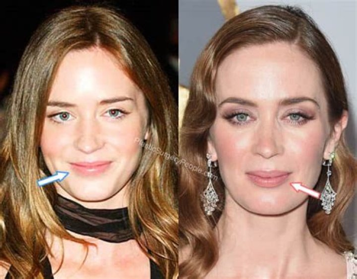 Emily Blunt Botox And Nose Job: Did She Underwent Surgery?