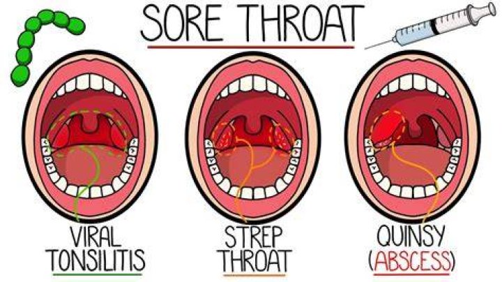 Exploring Sprite's Impact On Sore Throats