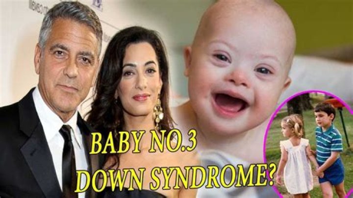 George Clooney's Son And The Question Of Down Syndrome