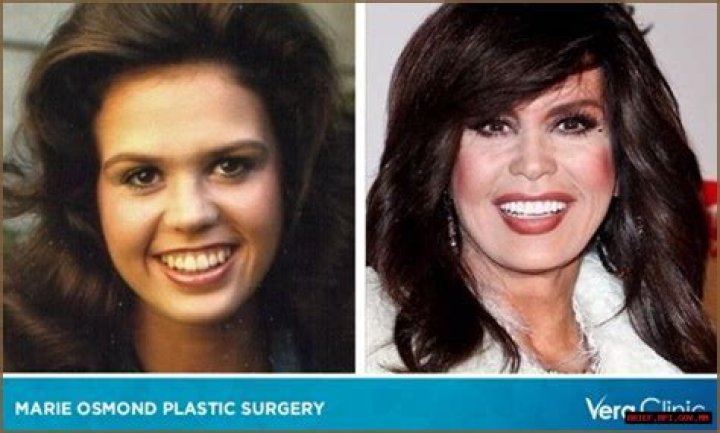 Has Marie Osmond Done Facelift And Plastic Surgery? Before And After Pics, Age And Height
