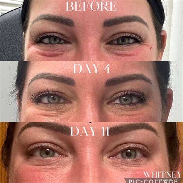 Jelly Roll Under Eye After Botox