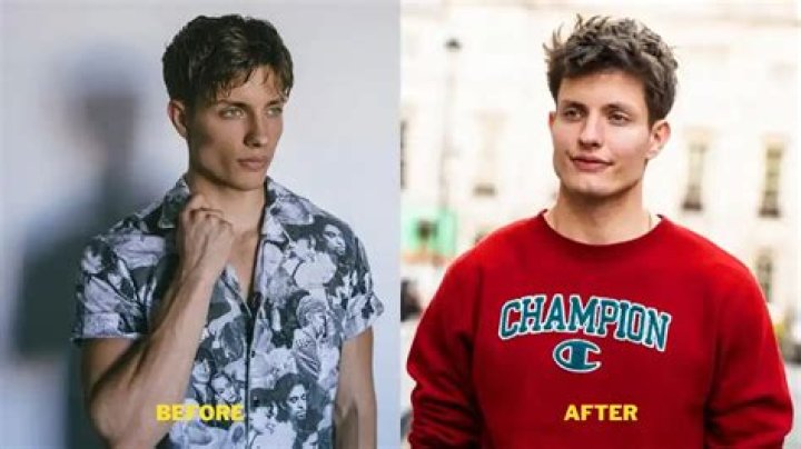 Matt Rife Before Veneers: Unveil The Transformation