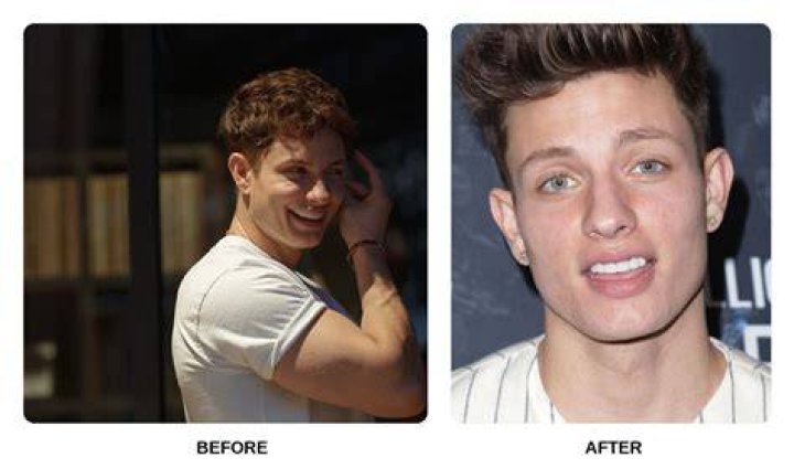 Revealing The Art Of Matt Rife's Teeth Veneers: Unlocking A Brighter Smile