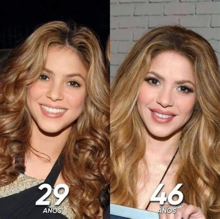 Shakira Botox And Lip Surgery – Before And After Photos