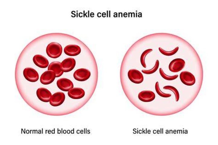 Sickle Cell Insights From Diane Abbott And James Thompson