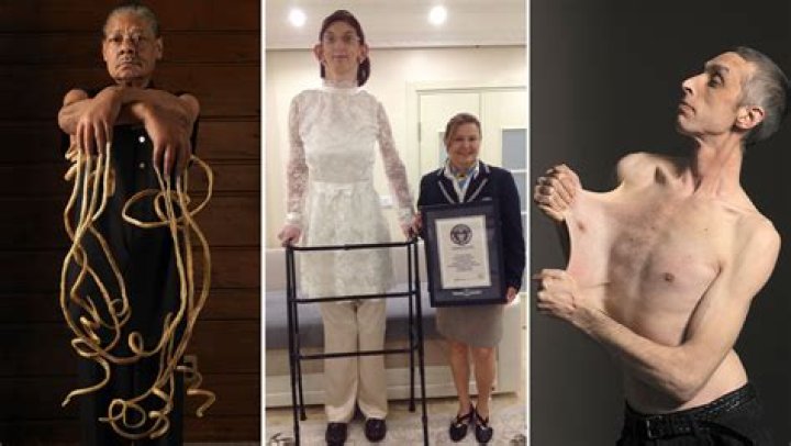 Skinniest Person in the World: Facts and Stories |