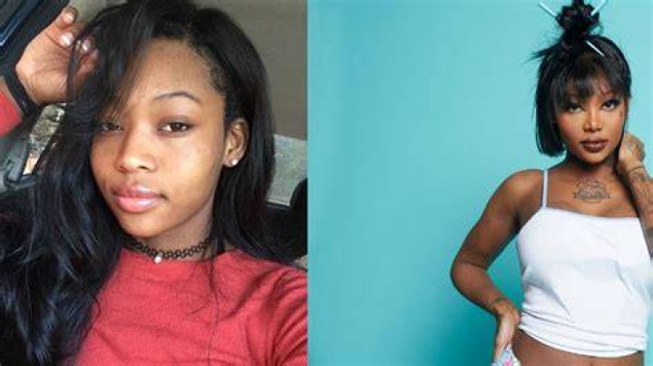 Summer Walker's Plastic Surgery Journey