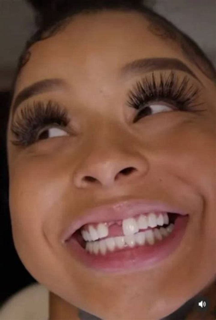 The Shocking Story Behind Chrisean's Lost Tooth