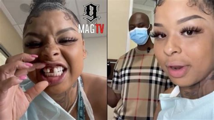 The Truth Behind Chrisean Rock's Lost Tooth