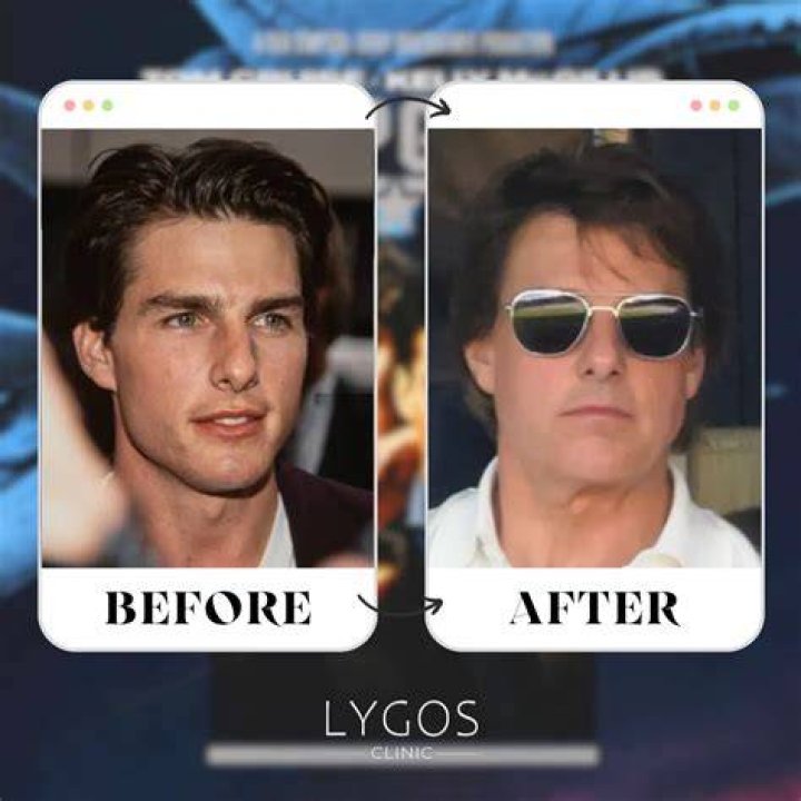 Tom Cruise's Nose Job Transformation Revealed