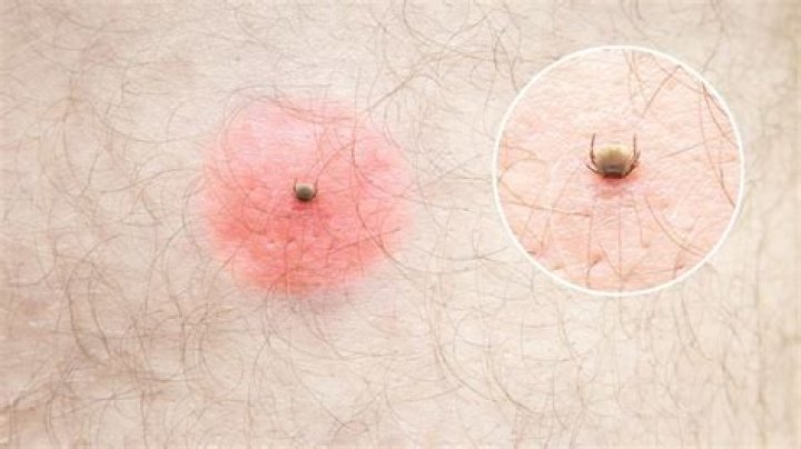 Uncover The Hidden World Of Mite Bites: Pictures Reveal Astonishing Truths