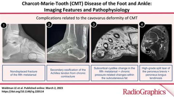 Uncovering The Impact Of Charcot-Marie-Tooth