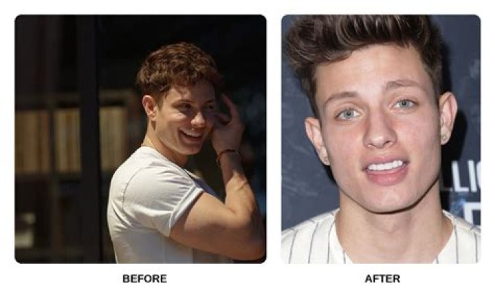 Unveiling Matt Rife's Dental Transformation: Discoveries And Insights