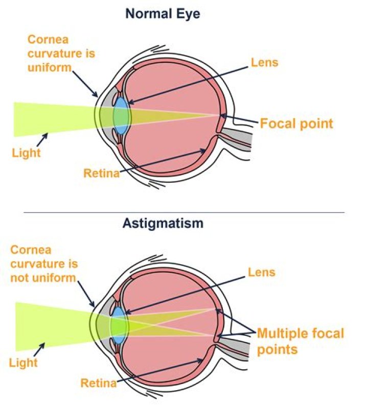 Unveiling The Enigma Of Stigmatism: Discoveries And Insights