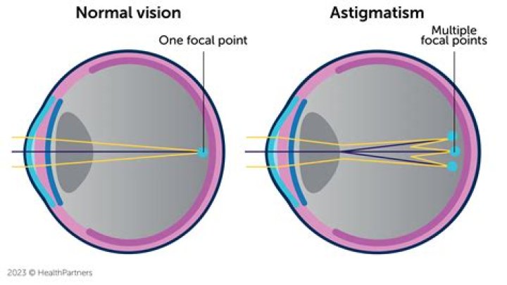 Unveiling The Secrets Of Astigmatism: A Journey Of Clarity