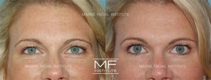 Unveiling The Secrets Of "Jelly Roll Botox Before And After"