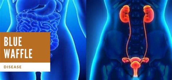 Unveiling The Truth: Blue Waffle Disease: Fact Vs. Fiction