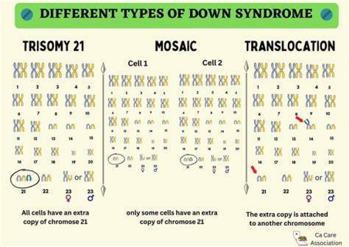 Unveiling The Truths And Triumphs Of Down Syndrome