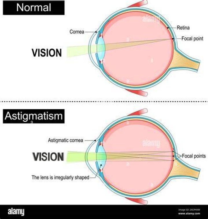 Unveiling The Visual World Of Astigmatism: Discoveries And Insights