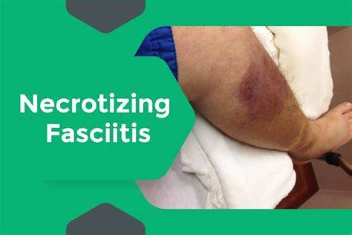 What You Need to Know About Necrotizing Fasciitis |