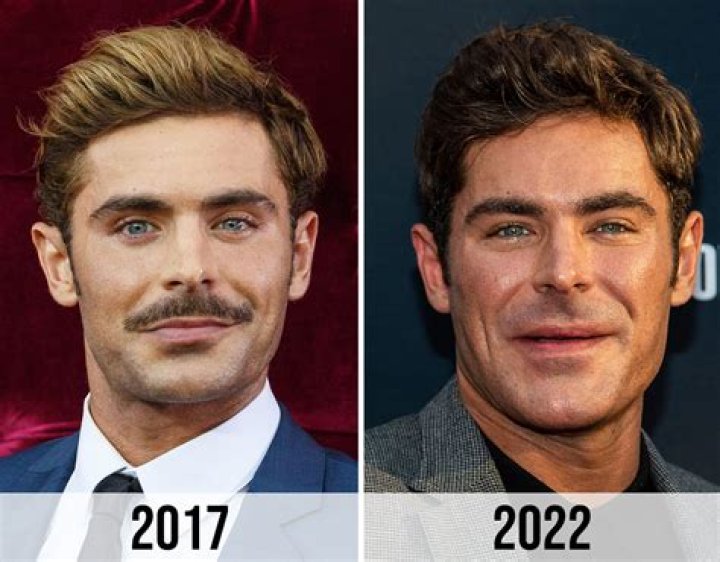 Zac Efron Botox And Jaw Surgery Before And After Plastic Surgery
